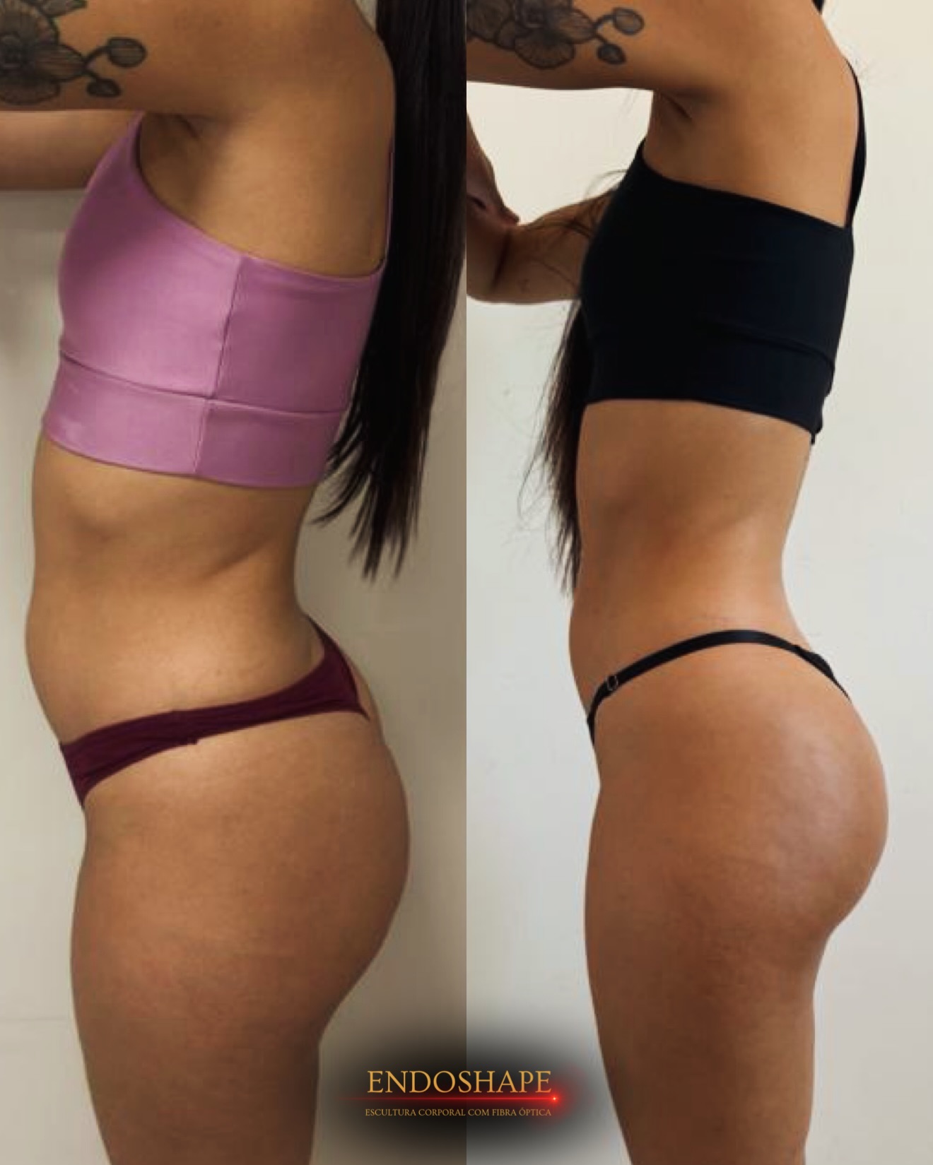 Resultado 2 do EndoShape — antes e depois