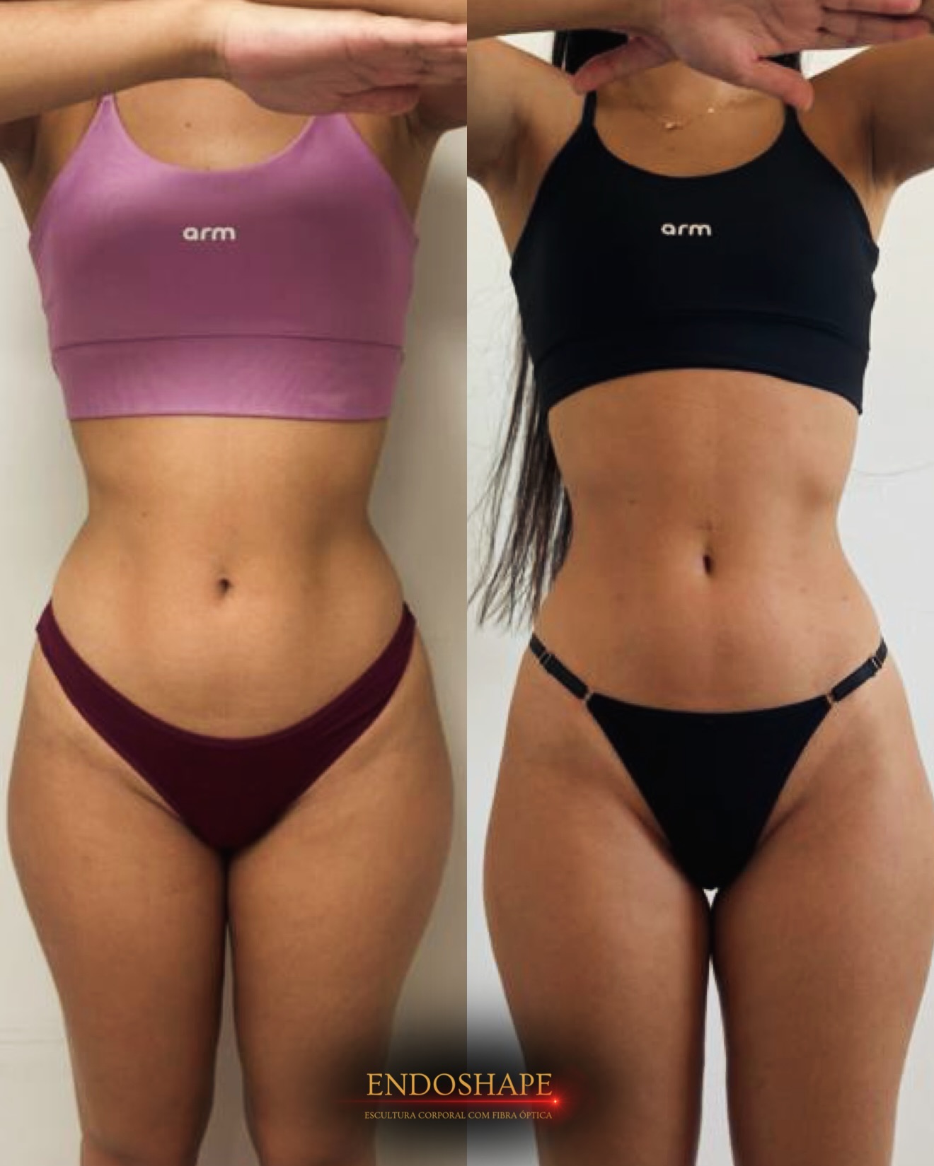 Resultado 1 do EndoShape — antes e depois