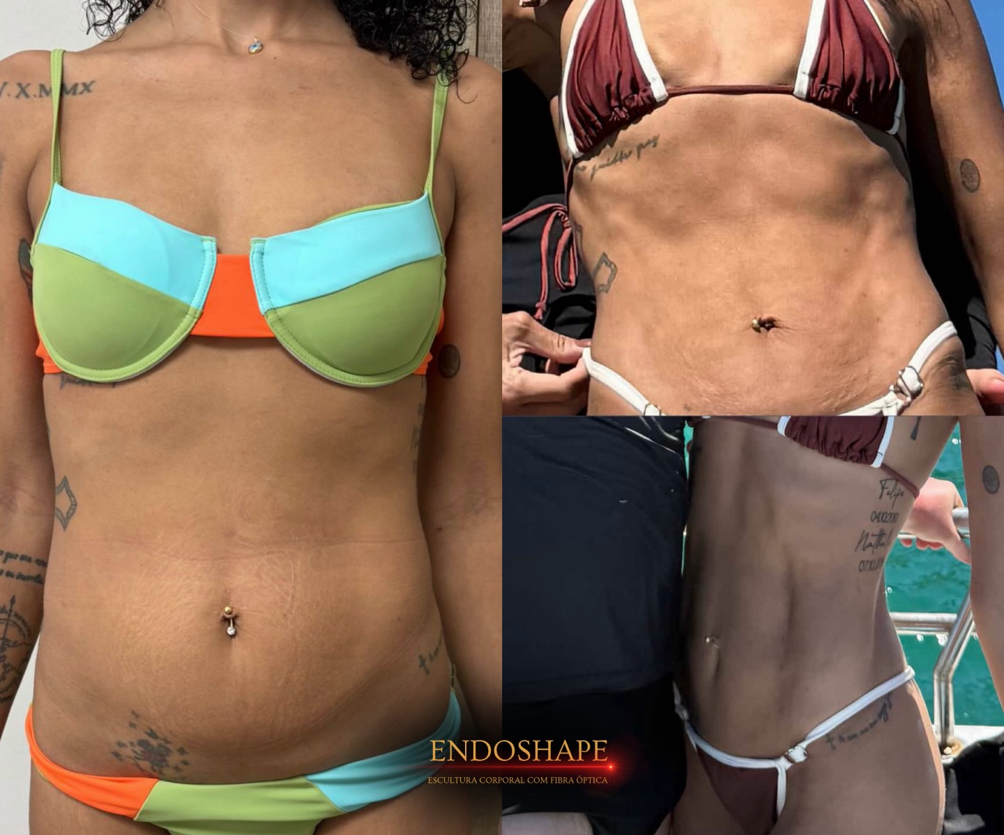 Resultado 3 do EndoShape — antes e depois